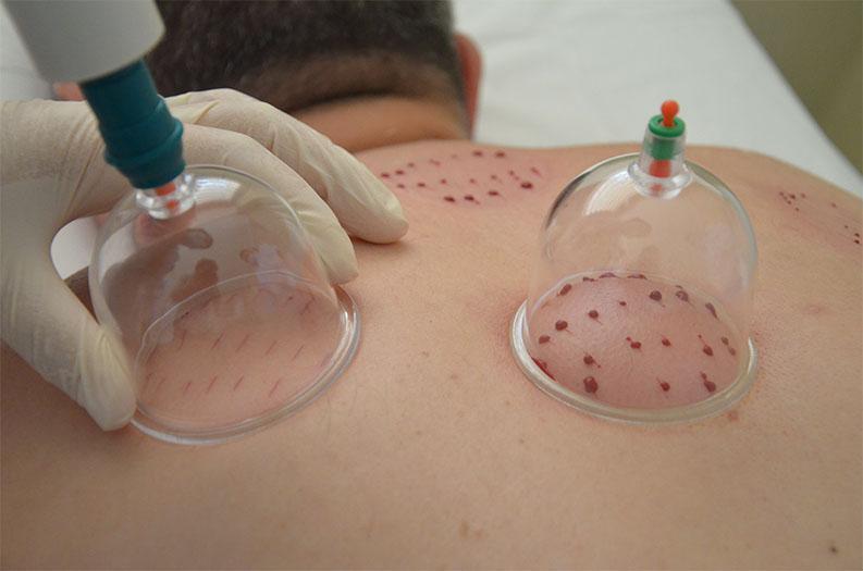 Kupa Tedavisi (Hacamat)